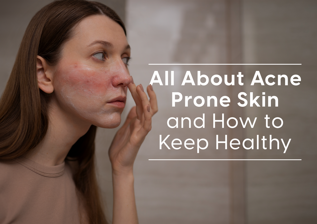 All About Acne Prone Skin and How to Keep Healthy